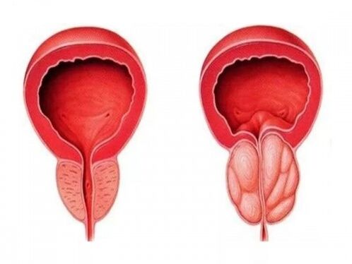 a prostate gland is healthy and inflamed