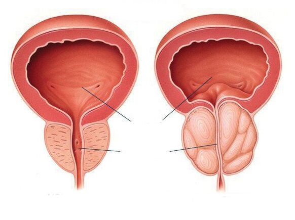 Papillary lesion in prostatic urethra - punticrisene.ro Papillary lesion prostate
